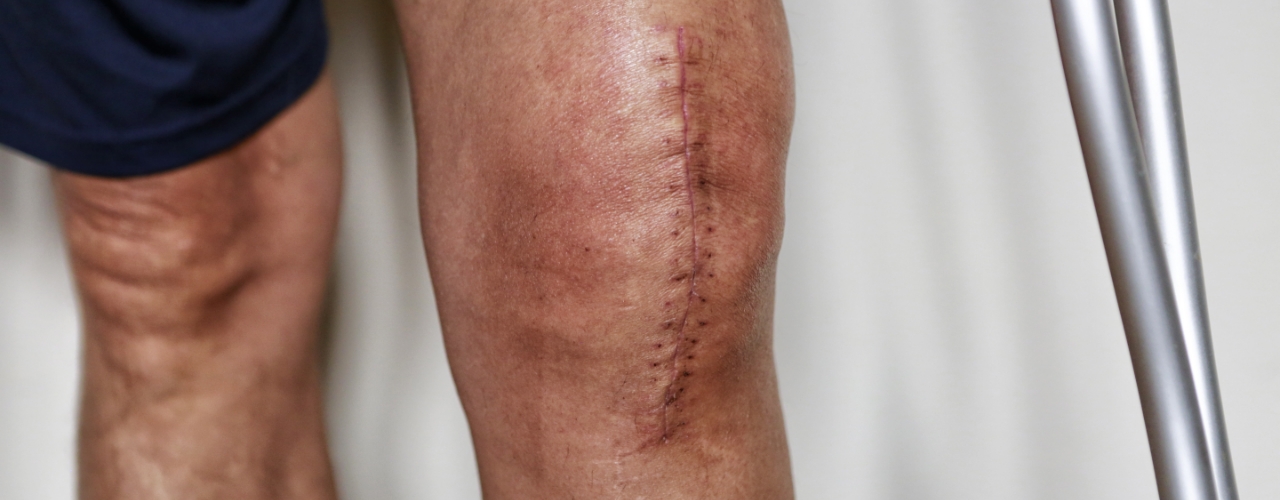 Total-joint-replacement-rehab-therapy-fit-physical-therapy-frisco-tx